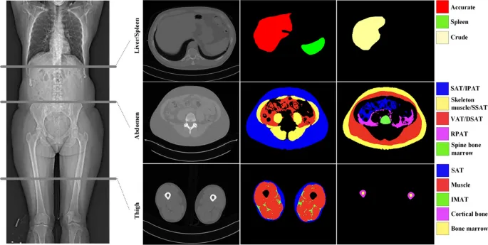 AI segmentation of abdominal organs on CT