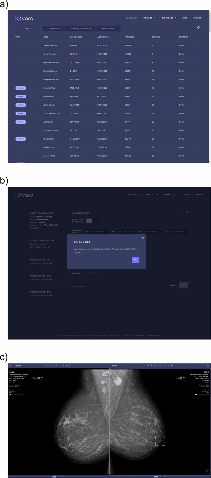 AI mammography interface with suspicious region highlighted