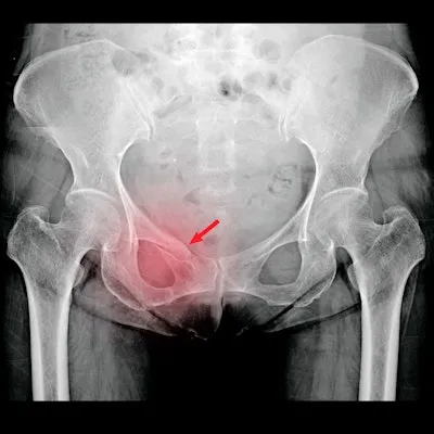 AI highlighting tumor on pelvic X-ray