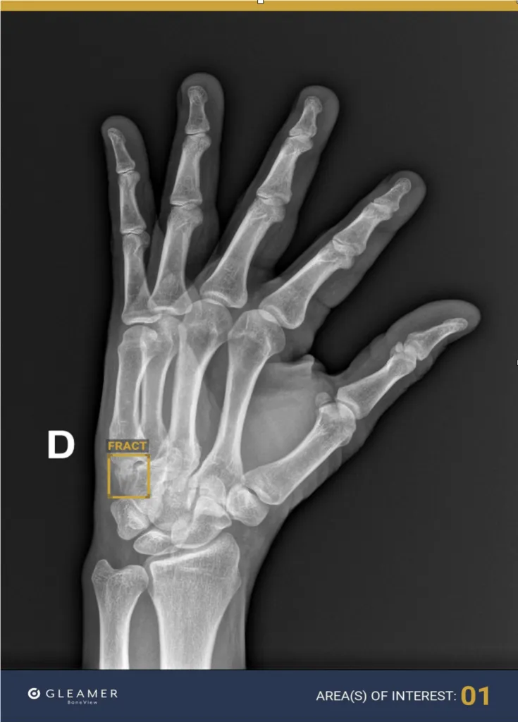 AI-detected scaphoid fracture on wrist X-ray