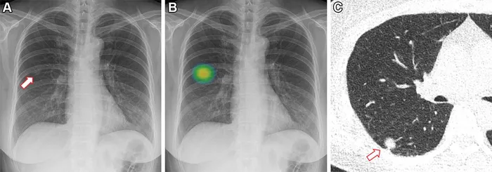 AI detection of pulmonary nodule on chest X-ray and CT