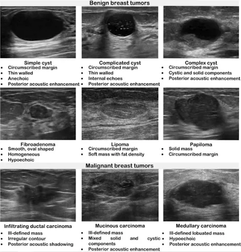 Ultrasound of benign and malignant breast tumors