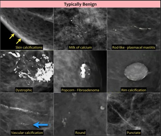 Mammogram showing various types of benign calcifications