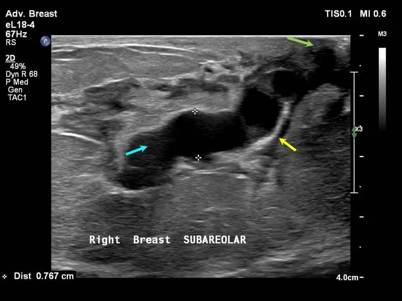 Ultrasound of duct ectasia with dilated duct and debris