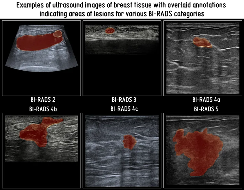 Ultrasound of breast lesions by BI-RADS category
