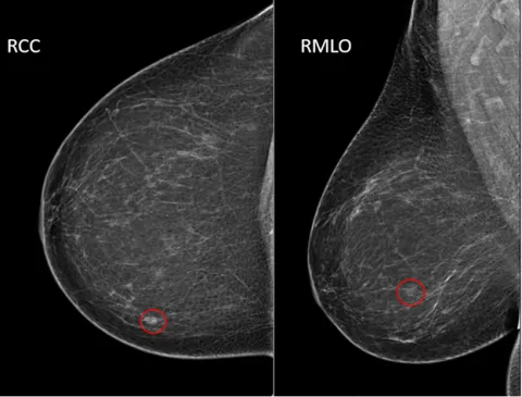 Mammogram with BI-RADS 4 lesion (RCC and RMLO views)