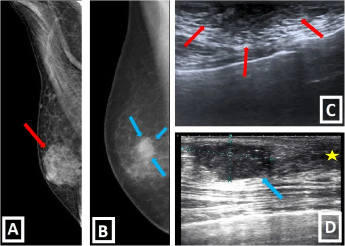 Male breast imaging: Mammography and ultrasound findings