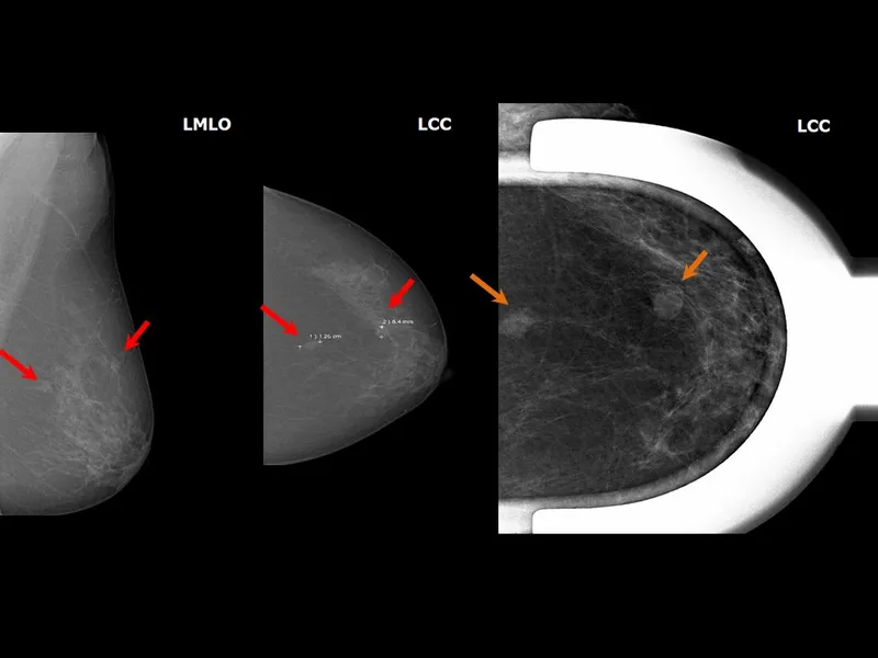 Mammography Views and Techniques