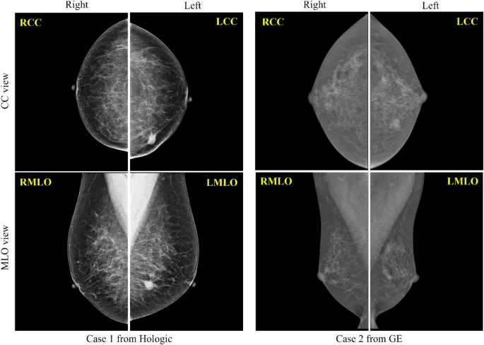 Mammography CC and MLO Views