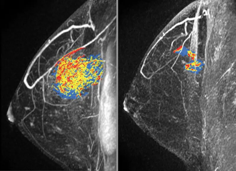 MRI showing post-treatment changes in breast