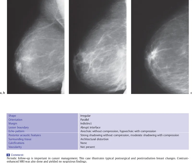 Mammogram: Post-lumpectomy scar and architectural distortion
