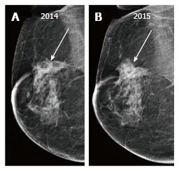 Mammogram showing post-treatment recurrence