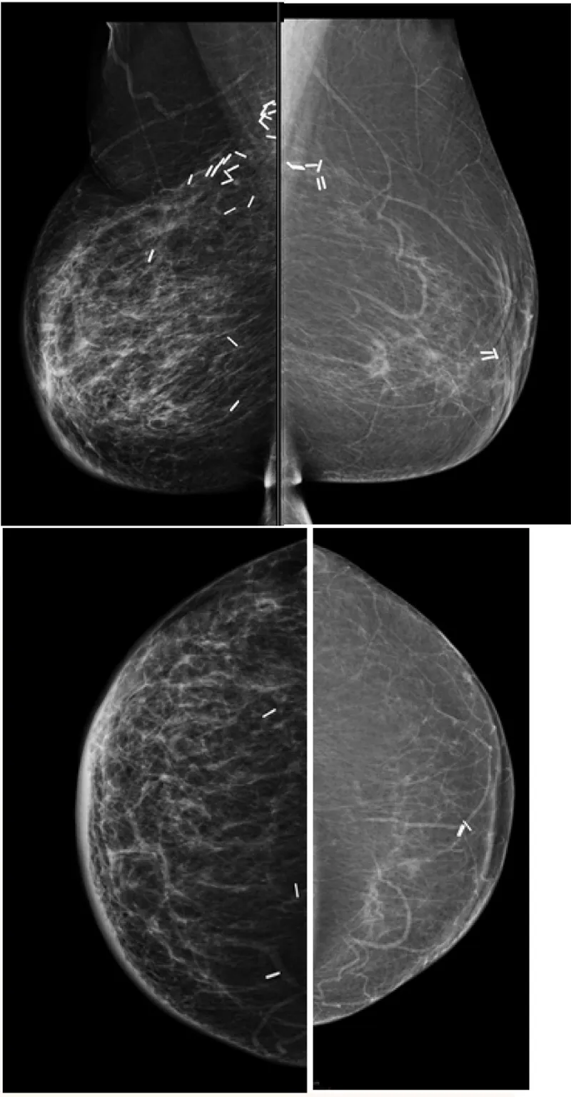 Post-lumpectomy mammogram with clips and scar tissue