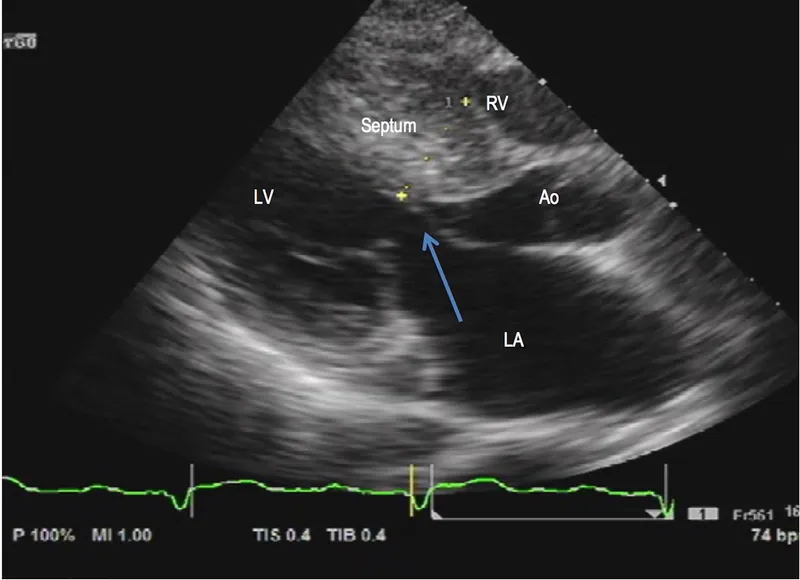 Echocardiogram: Hypertrophic Cardiomyopathy with SAM