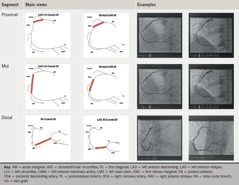 Coronary Artery Angiography Views and Anatomy