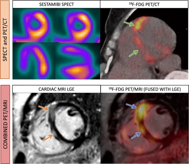 Cardiac Imaging Modalities in Ischemic Heart Disease