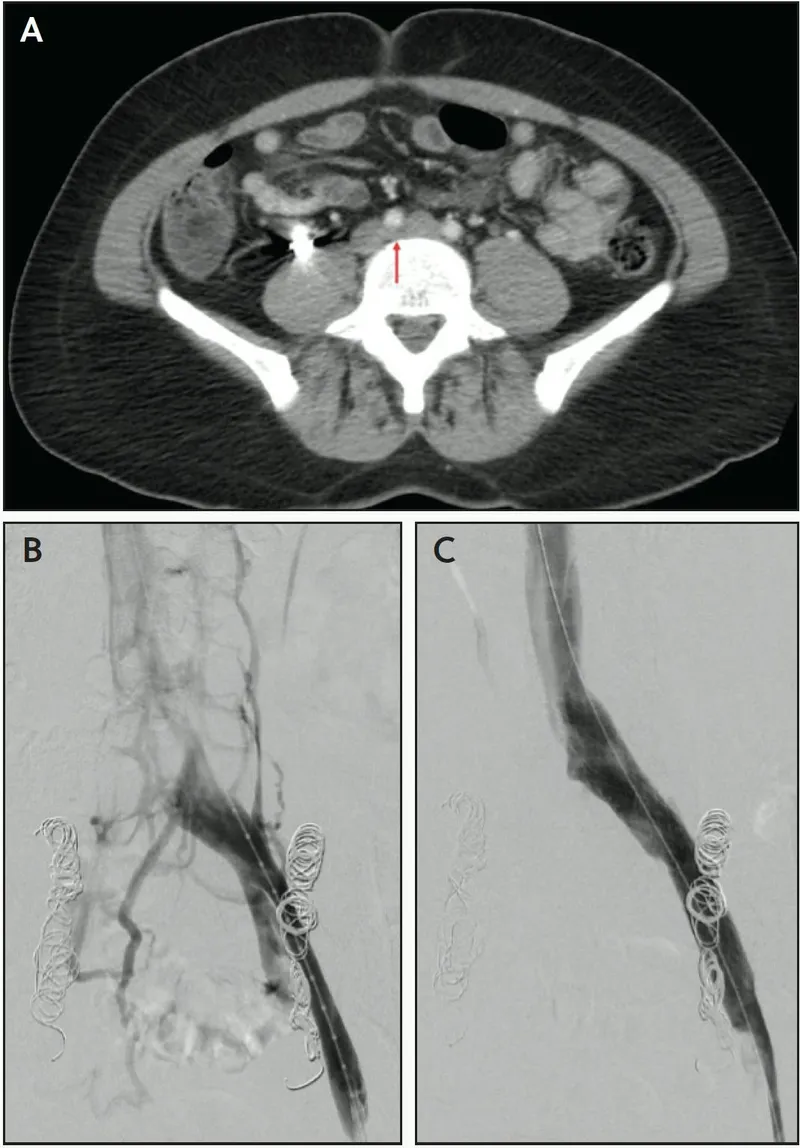 May-Thurner Syndrome CT and venogram