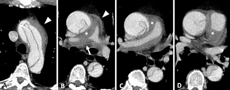 CT Chest Trauma: Aortic Injury and Pulmonary Contusion