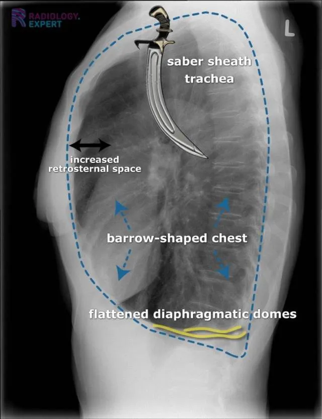Chest X-ray: COPD hyperinflation signs