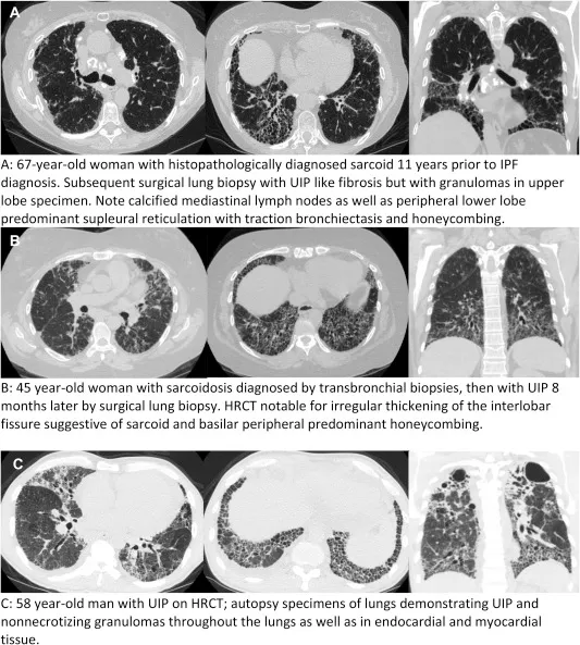 HRCT Sarcoidosis vs UIP