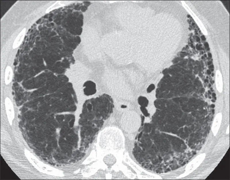 HRCT chest showing honeycombing and traction bronchiectasis