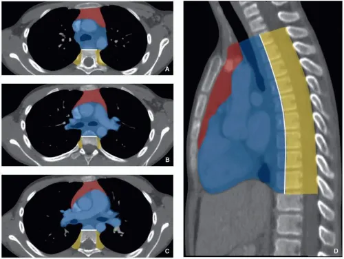 Mediastinal compartments on CT (ITMIG classification)