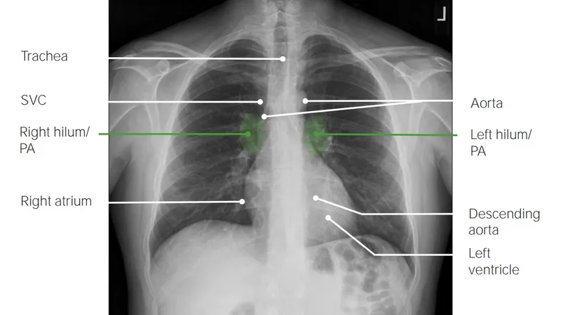 Normal Chest X-ray PA View with Key Anatomical Labels