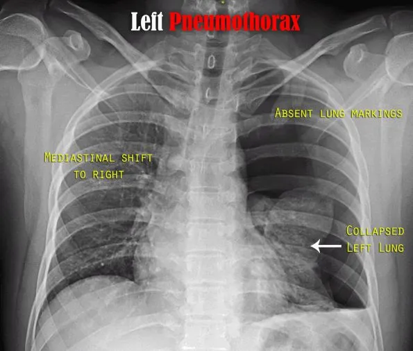 Tension pneumothorax with mediastinal shift