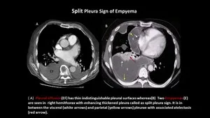 CECT Chest: Split Pleura Sign of Empyema