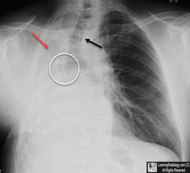 Post-pneumonectomy chest X-ray with annotations