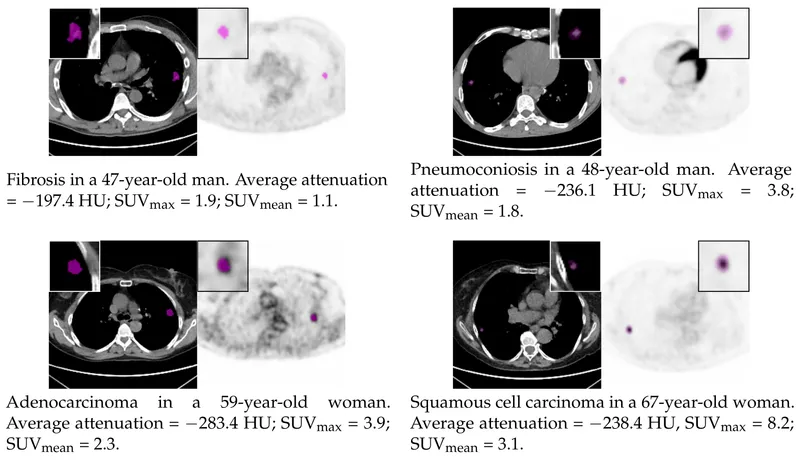 CT/PET: Benign vs. malignant pulmonary nodules