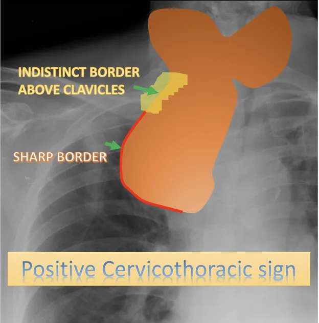 Positive Cervicothoracic sign on chest X-ray