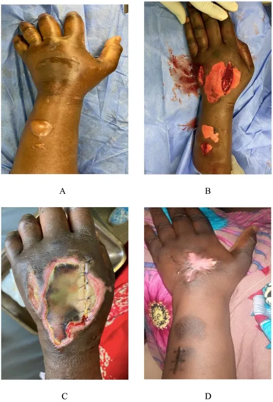 Contrast extravasation injury progression