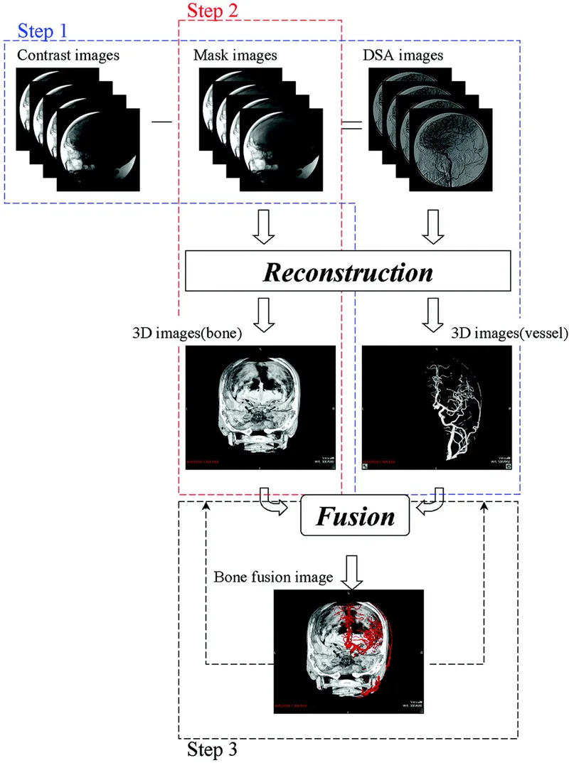 DSA technique steps: subtraction, reconstruction, fusion