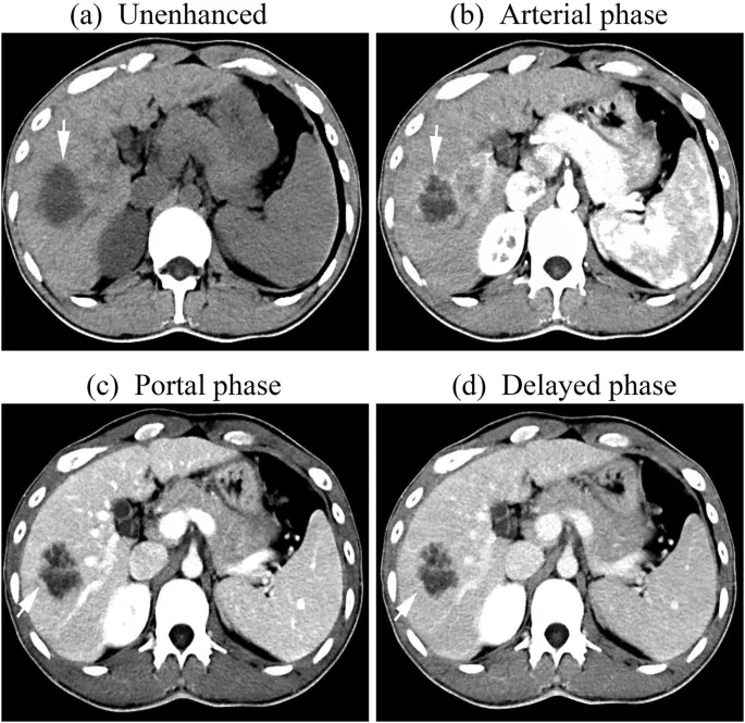 CT contrast phases of liver lesion