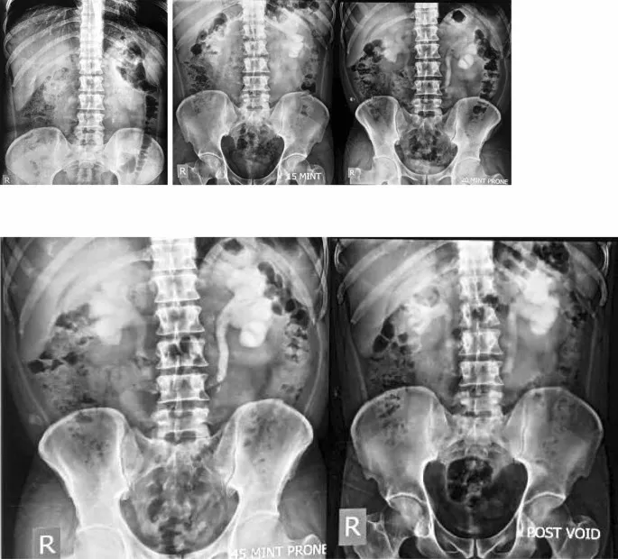 IVU timed sequence showing contrast passage