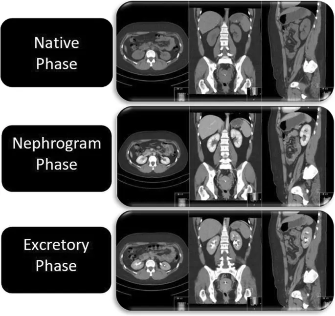 CT Urogram Phases: Native, Nephrogram, Excretory
