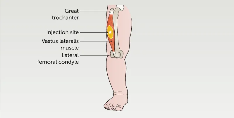 IM Epinephrine Injection Site: Anterolateral Thigh