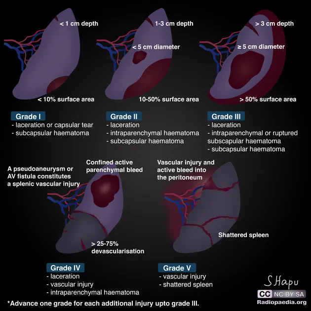 AAST Splenic Injury Grading