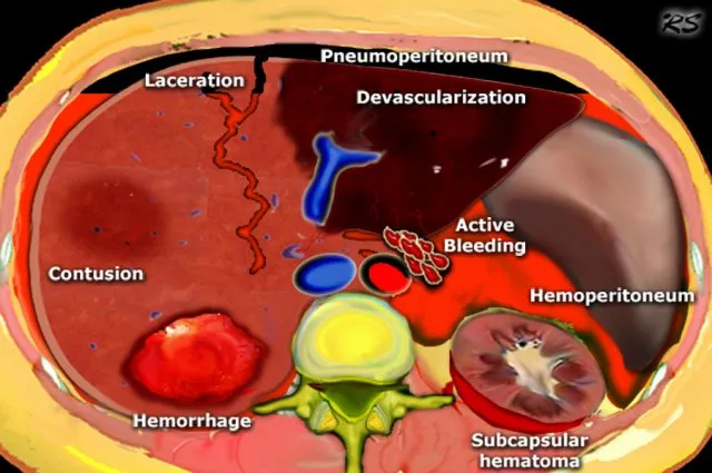 Abdominal Trauma Findings Diagram