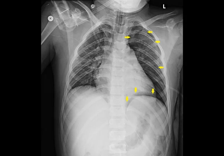 Chest X-ray showing pneumothorax with arrows