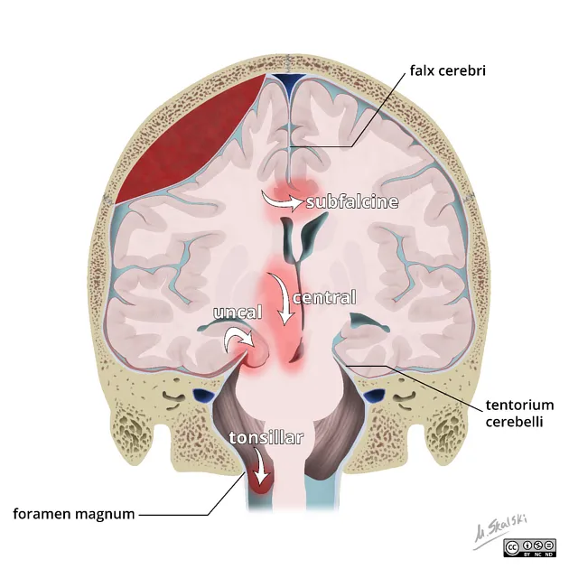 Brain herniation types