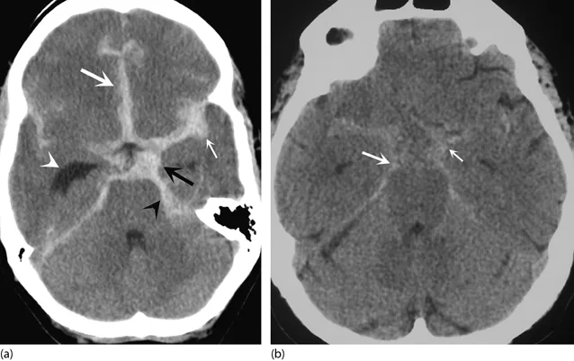 CT scans comparing EDH, SDH, SAH, ICH