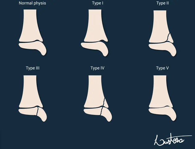 Salter-Harris Fracture Types Illustration