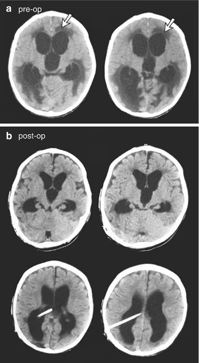 Axial CT brain: Hydrocephalus pre- and post-shunt
