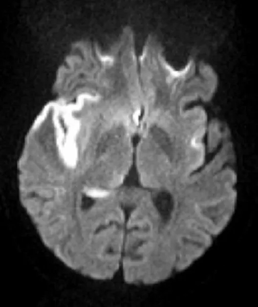 Herpes simplex encephalitis DWI restriction