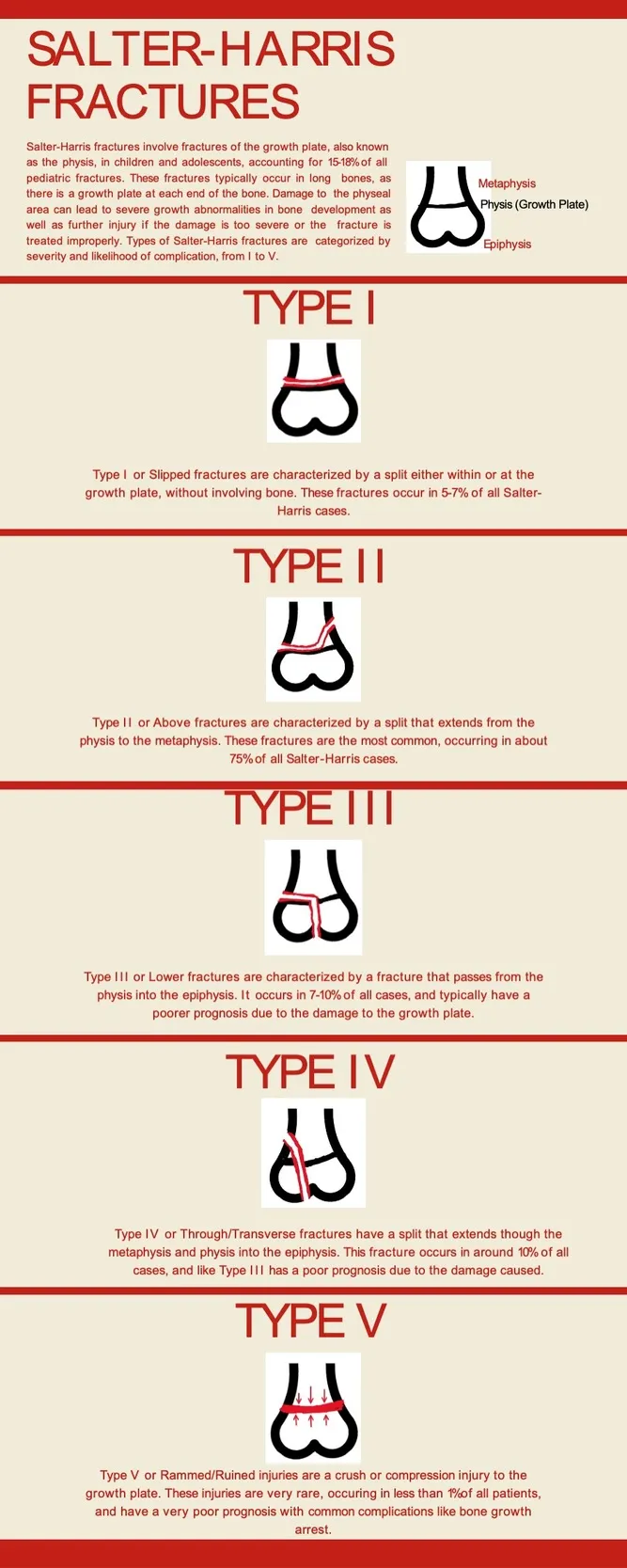 Salter-Harris Fracture Types I-V Diagram
