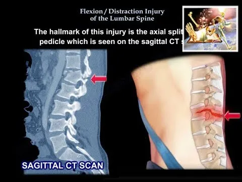 Sagittal CT and diagram of lumbar Chance fracture
