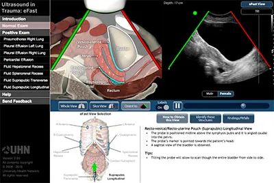 eFAST Suprapubic Longitudinal View Diagram