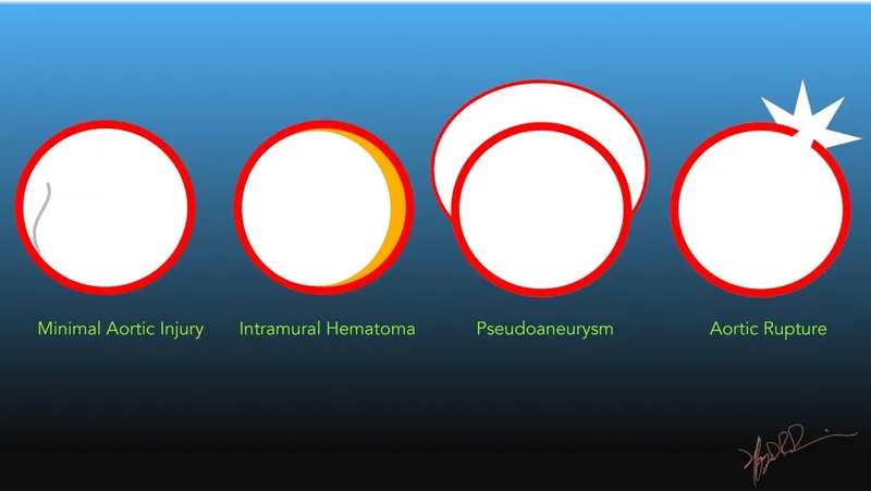 Diagram of traumatic aortic injury types